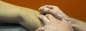Dry needling