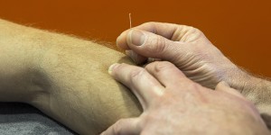 Dry needling