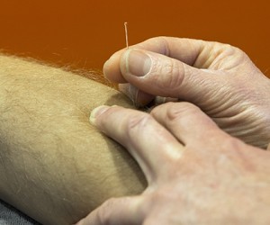Dry needling