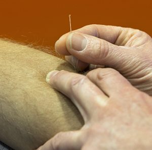 Dry needling